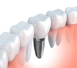 dental implant