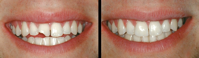 chipped tooth repair after - Wake Orthodontics & Pediatric Dentistry