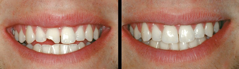 Before & After Photos, Cracked Tooth Repair Gallery