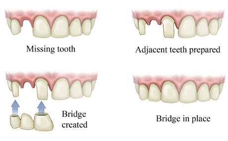 dental bridge illustration