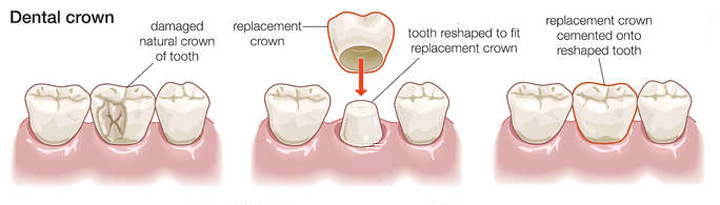dental crown 101