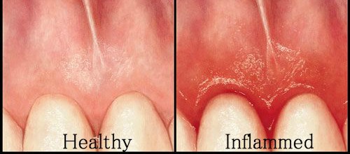 healthy gums vs perio