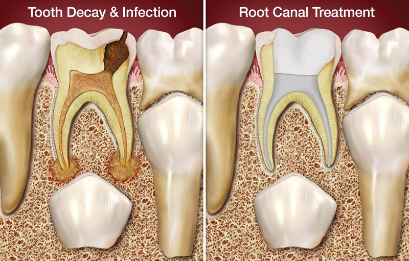 root canal treatment inside tooth