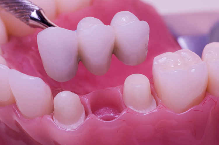 three tooth dental bridge