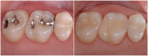 tooth colored fillings